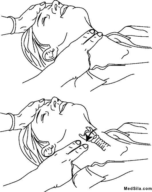 Прощупывание пульса на сонных артериях.