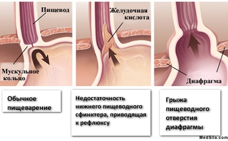 причины ГЭРБ